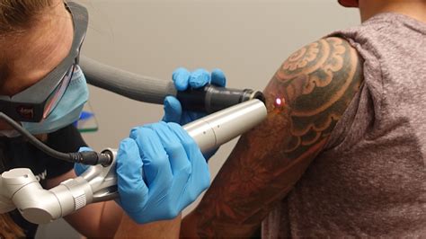 Denver Co Tattoo Removal