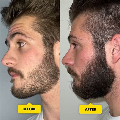 Derma Roller Beard