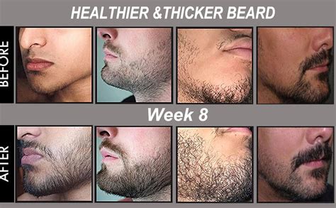 Derma Roller Beard Growth Before And After