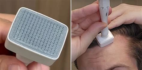 Derma Stamp and Minoxidil Synergy