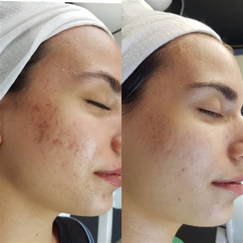 Derma stamp treatment process