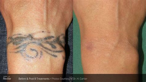 Tattoo Removal Using Laser, Dermabrasion, Surgical