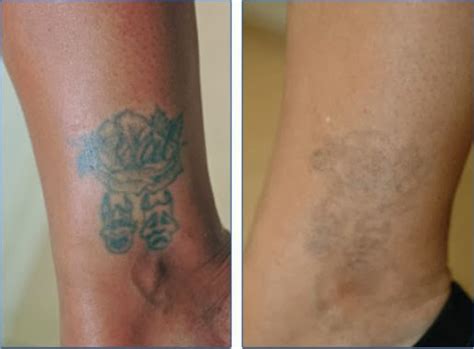 1000+ images about Dermabrasion Tattoo Removal on