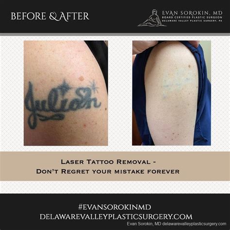 Before & After Gallery Tattoo Removal Derick Dermatology