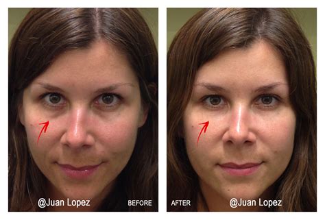 Dermal Fillers for Tear Troughs