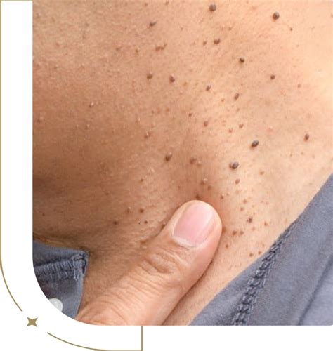 Top Dermatologist for Skin Tag Removal Near Me