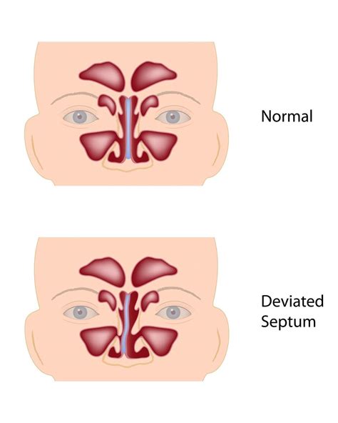 Deviated Septum: Relief, Causes & Treatment Options