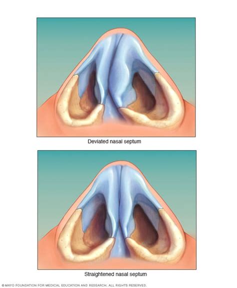 Deviated Septum Image
