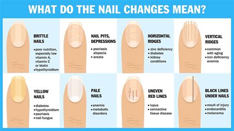 Diabetes Nail Health Chart