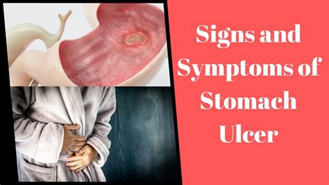 Diagnosing Stomach Ulcer