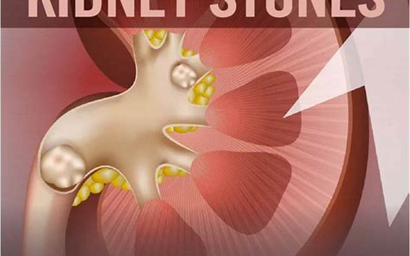 Diagnosis Of Kidney Stones