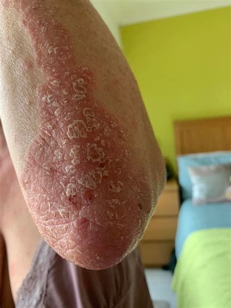 Diet For Psoriasis Reddit