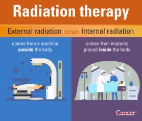 Different Types of Radiation Therapy Used