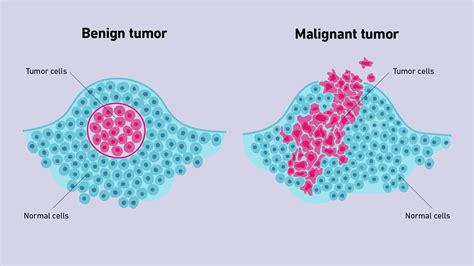 Different Types of Lumps Benign vs. Malignant