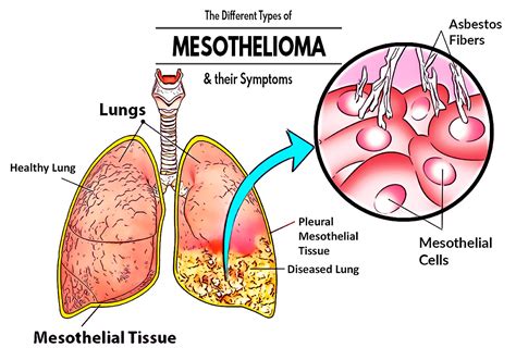 Different Types of Mesothelioma
