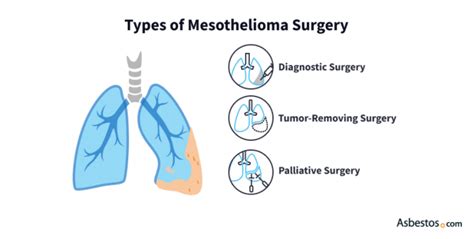 Different Types of Mesothelioma Surgery