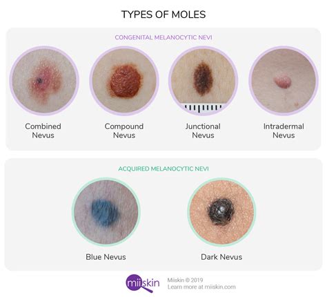 Different types of mole