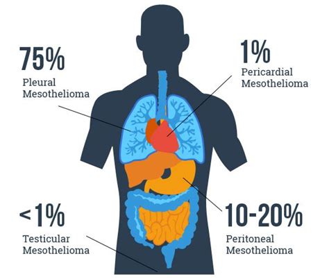 Different Types of Mesothelioma
