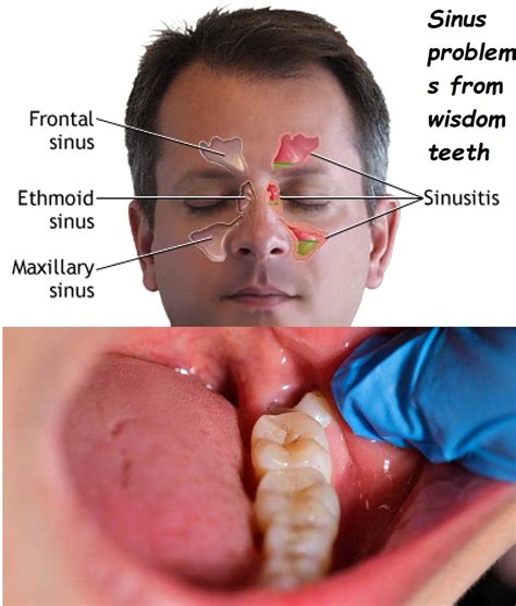 Differentiating Wisdom Teeth Pain from Regular Sinusitis
