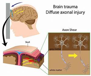 Diffuse Axonal Injuries image
