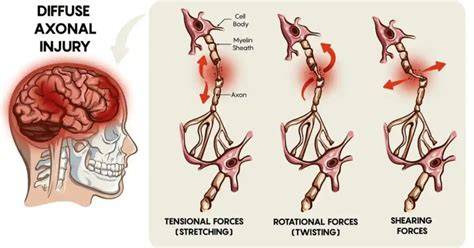 Diffuse Axonal Injury: Understanding Causes & Risks