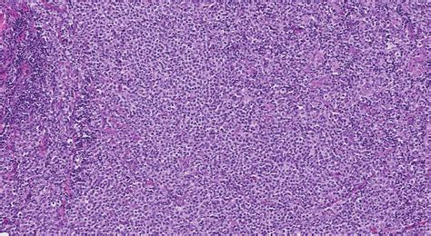 Diffuse Large B-Cell Lymphoma: Deteksi & Penanganan