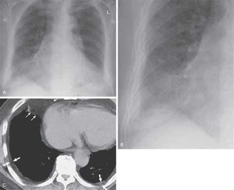 Diffuse Pleural Thickening on X-Ray