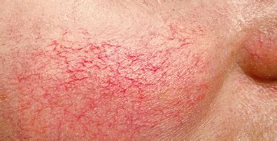 Understanding Diffuse Redness: Causes and Treatment Options