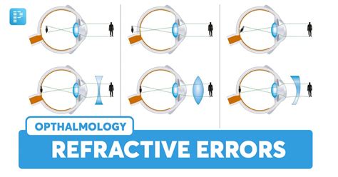 Digging Deeper Refractive Errors