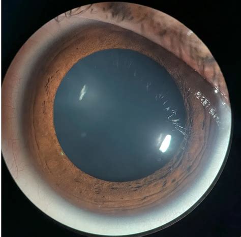 Dilation: The Key to a Clear View