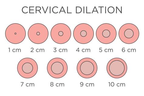 Dilation Chart Cervix