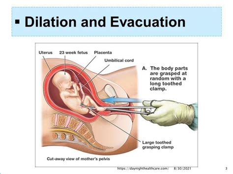 Dilation and Evacuation