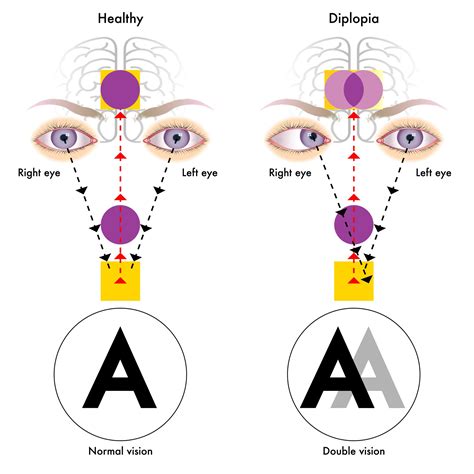 Diplopia (Double Vision)