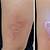 Disappearing Ink Tattoo Removal