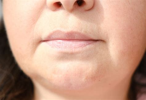 Unveiling the Causes and Remedies for Dark Skin Around Mouth