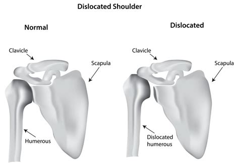 Dislocation: Causes, Symptoms & Fast Relief