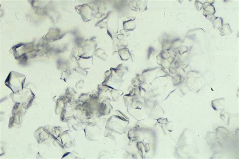 Dissolving Struvite Stones