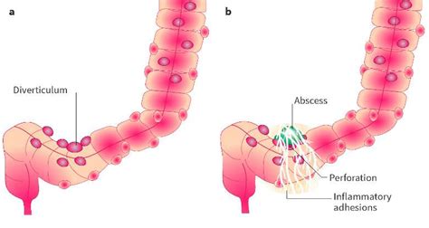 Diverticulitis with Abscess: A Deeper Dive