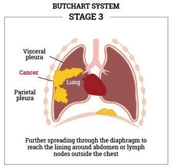 Diving Into the Butchart System for Mesothelioma