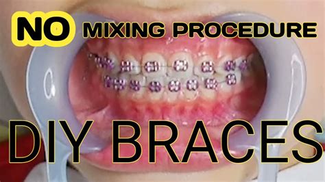 Diy Braces
