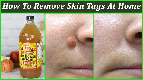 10 Ingenious Ways You Can Perform DIY Skin Tag Removal at Home