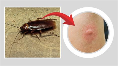 The Surprising Truth about Cockroach Bites: Protect Yourself and Your Loved Ones from These Unwanted Pests