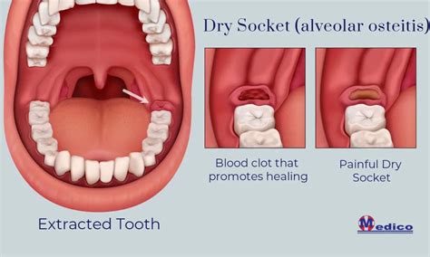 Do Sutures Prevent Dry Socket