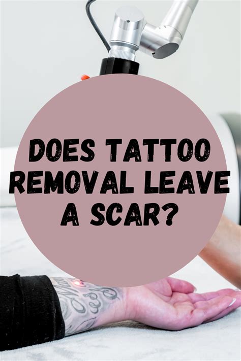 Laser Tattoo Removal Leave Scars Best Tattoo Ideas