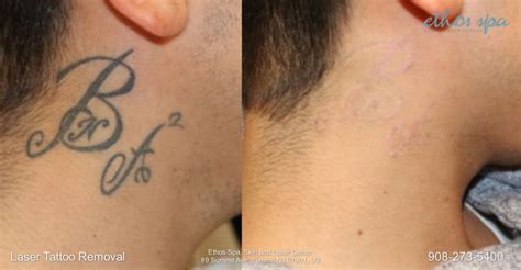 Scar after laser removal of tattoo Stock Image C010