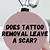Does Tattoo Removal Leave A Scar