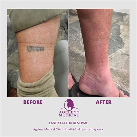 Easy Tattoo Removal Does Tattoo Removal Work Reddit How To