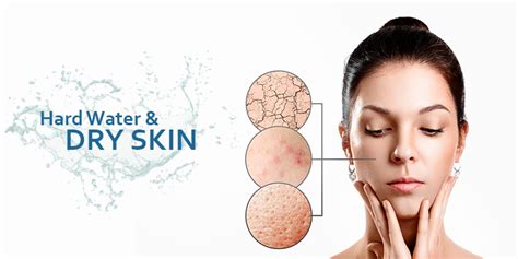 Unveiling the Truth: Can Chilling Waters Suck out Skin's Moisture?