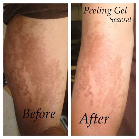 Eliminate The Odor: Understanding Why Dead Skin Smells