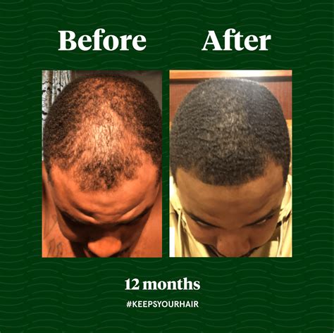 Does Keeps Work For Hair